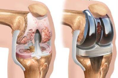 Knee Replacement Education
